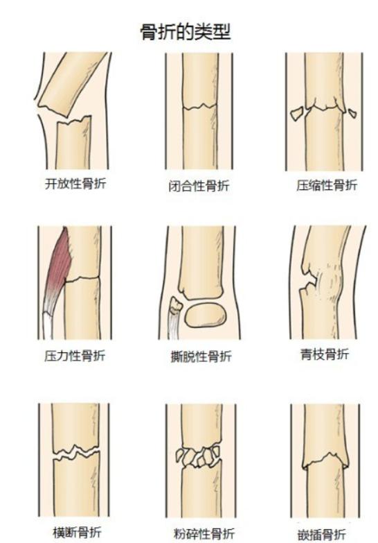 折断的骨能够痊愈主要与什么有关折断的骨骼如何痊愈，深入了解骨骼再生与恢复的关键因素