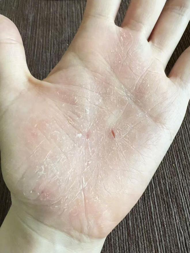 张靓颖一伸懒腰手掌就流血张靓颖一伸懒腰手掌就流血，神秘现象的背后真相